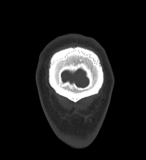 Occipital spur and Currarino type A atlas anomaly (Radiopaedia 87027-103285 Coronal bone window 141).jpg