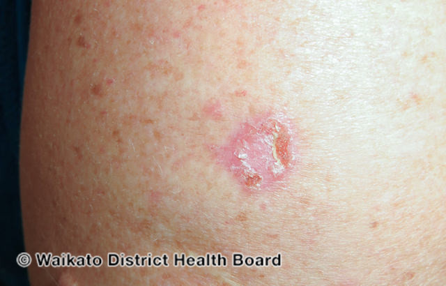 File:Superficial basal cell carcinoma, arm (DermNet NZ sbcc-arm-24-wdhb).jpg