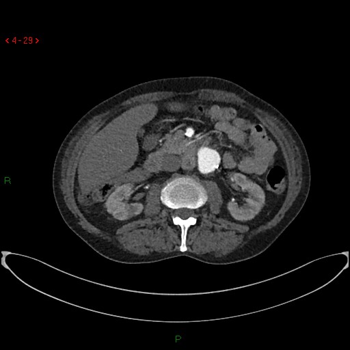File:Abdominal aortic aneurysm (Radiopaedia 16155-15834 Axial C+ arterial phase 9).jpg