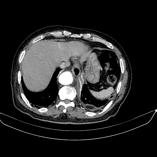 File:Abdominal aortic aneurysm (Radiopaedia 67117-76452 Axial C+ arterial phase 19).jpg