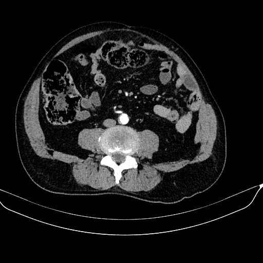 Abdominal aortic aneurysm (Radiopaedia 67117-76452 Axial C+ arterial phase 82).jpg