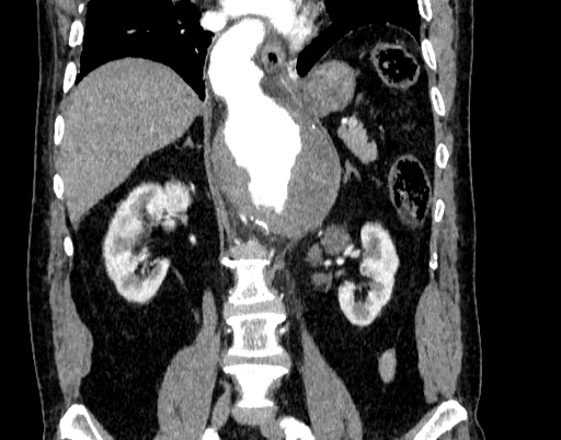 Abdominal aortic aneurysm (Radiopaedia 67117-76452 Coronal C+ arterial phase 59).jpg