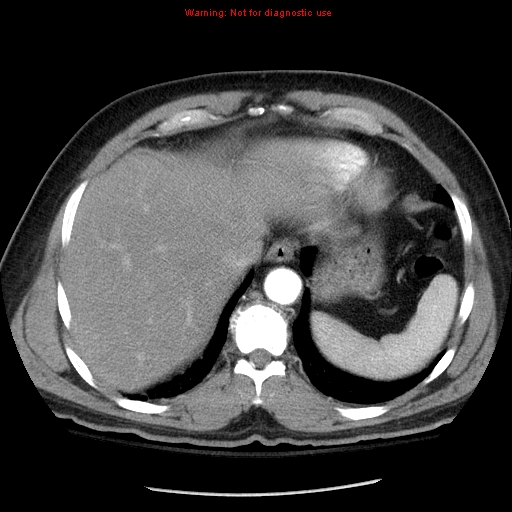 Abdominal aortic aneurysm (Radiopaedia 8190-9038 Axial C+ arterial phase 10).jpg