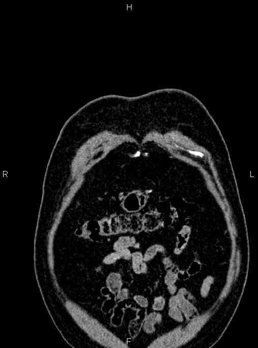 Abdominal aortic aneurysm (Radiopaedia 83094-97462 Coronal renal cortical phase 12).jpg