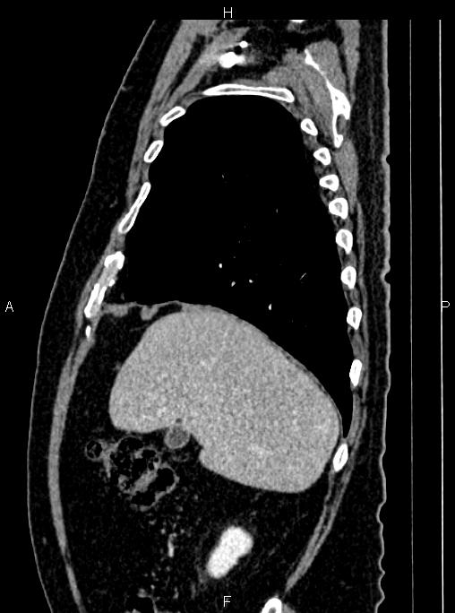 Abdominal aortic aneurysm (Radiopaedia 83094-97462 Sagittal renal cortical phase 30).jpg
