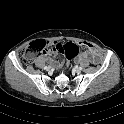 File:Abdominal aortic aneurysm (Radiopaedia 83581-98689 Axial C+ portal venous phase 85).jpg