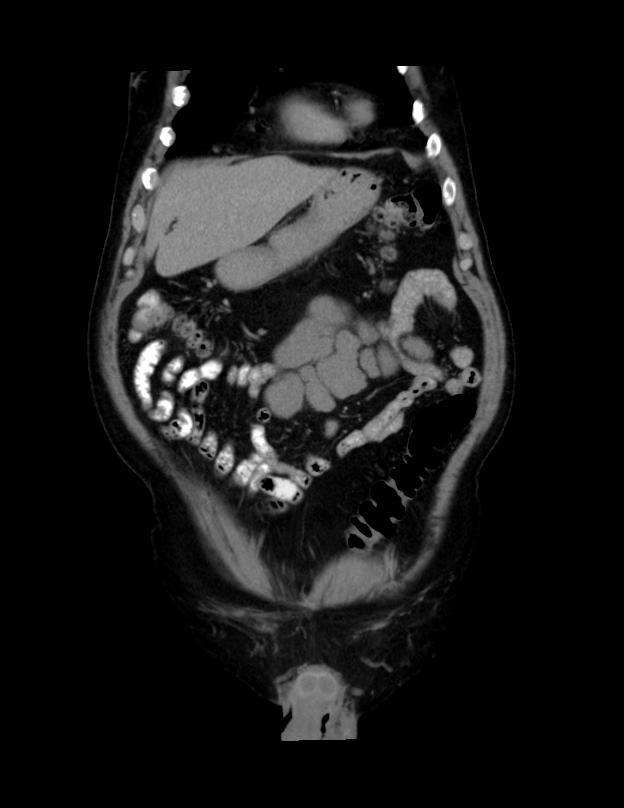 Abdominal lymphoma - with sandwich sign (Radiopaedia 53486-59492 C+ portal venous phase 46).jpg