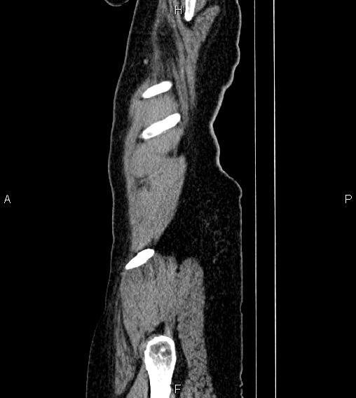 Abdominal lymphoma with sandwich sign (Radiopaedia 84378-99704 Sagittal C+ portal venous phase 92).jpg
