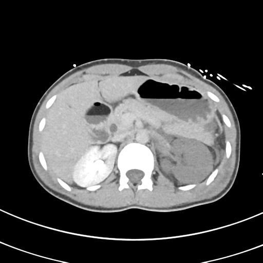 File:Abdominal multi-trauma - devascularised kidney and liver, spleen and pancreatic lacerations (Radiopaedia 34984-36486 Axial C+ delayed 24).png