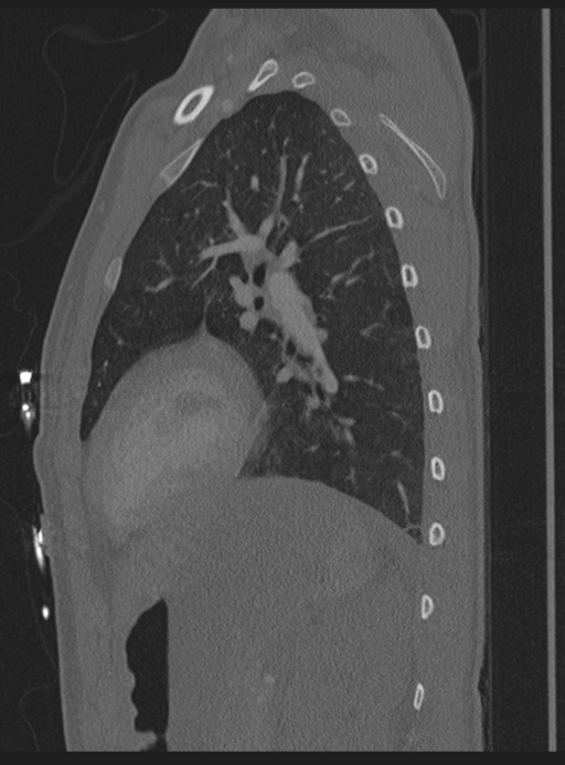 Abdominal multi-trauma - devascularised kidney and liver, spleen and pancreatic lacerations (Radiopaedia 34984-36486 Sagittal bone window 2).png