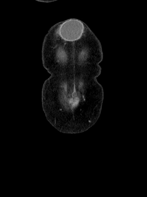 Abdominal wall and retroperitoneal tuberculosis (Radiopaedia 88137-104729 Coronal C+ portal venous phase 8).jpg