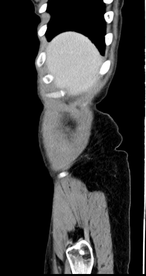 Abdominal wall and retroperitoneal tuberculosis (Radiopaedia 88137-104729 Sagittal C+ portal venous phase 136).jpg
