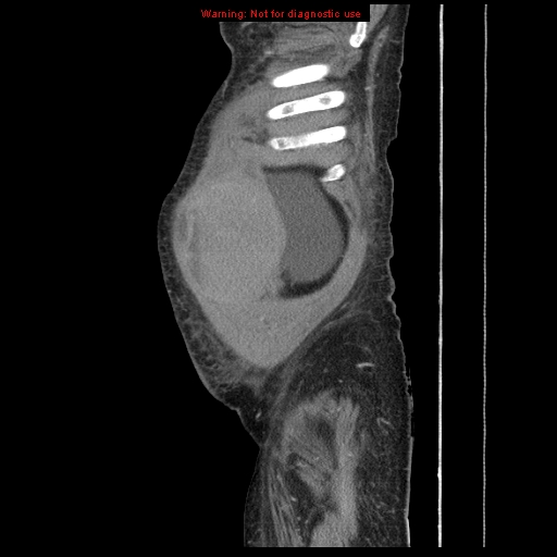 Abdominal wall hematoma (Radiopaedia 9427-10112 Sagittal C+ portal venous phase 100).jpg