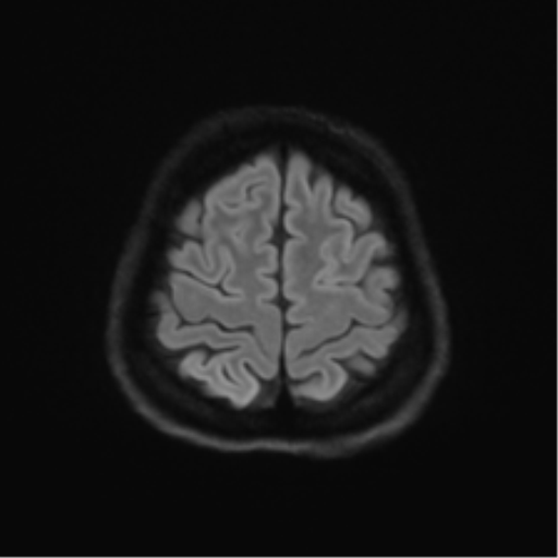 Abducens nerve palsy (Radiopaedia 51069-56648 Axial DWI 50).png
