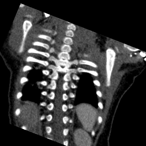 File:Aberrant left pulmonary artery (pulmonary sling) (Radiopaedia 42323-45435 Coronal C+ CTPA 4).jpg