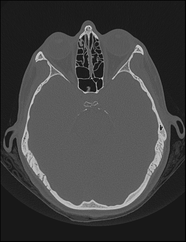 Aberrant right internal carotid artery (Radiopaedia 65191-74198 Axial non-contrast 64).jpg