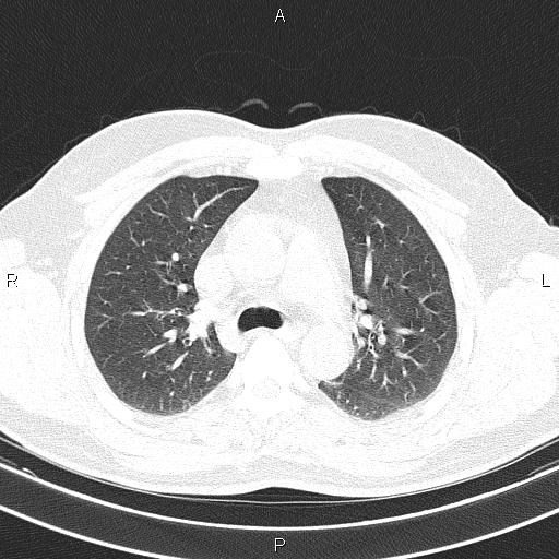 File:Aberrant right subclavian artery (Radiopaedia 87093-103354 Axial lung window 40).jpg