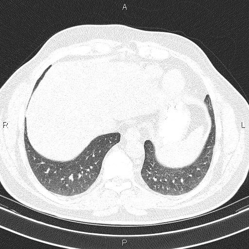 Aberrant right subclavian artery (Radiopaedia 87093-103354 Axial lung window 89).jpg