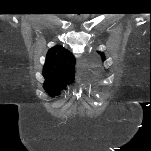 File:Aberrant right subclavian artery with Kommerell diverticulum (Radiopaedia 47982-52769 Coronal C+ arterial phase 11).png