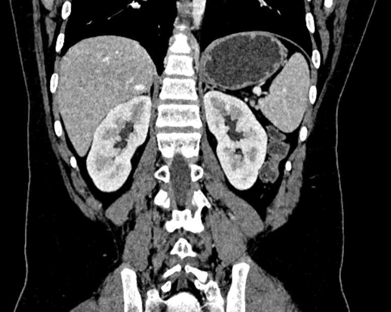 Accessory right inferior hepatic vein (Radiopaedia 75207-86305 Coronal C+ portal venous phase 53).jpg