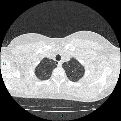File:Accidental foreign body aspiration (seamstress needle) (Radiopaedia 77740-89983 Axial lung window 8).jpg