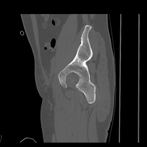 Acetabular and ilial fractures (Radiopaedia 59084-66378 Sagittal bone window 31).jpg