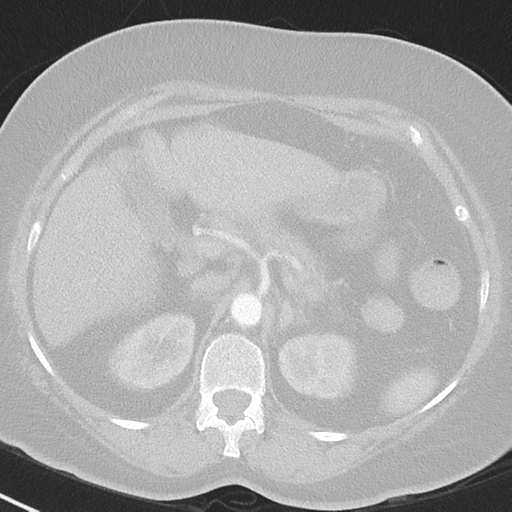 File:Achalasia (Radiopaedia 47147-51685 Axial lung window 51).png
