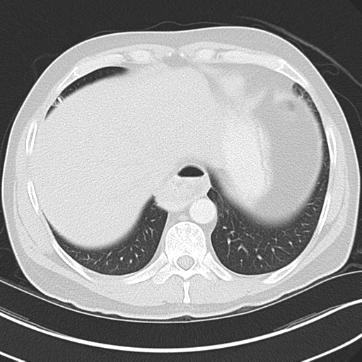 Achalasia of the cardia (Radiopaedia 38497-40595 Axial lung window 43).png