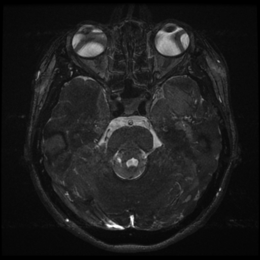 Acoustic neuroma (Radiopaedia 34049-35283 Axial 79).png