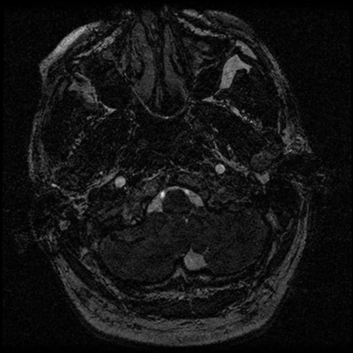 File:Acoustic schwannoma (Radiopaedia 39170-41387 Axial FIESTA 15).png