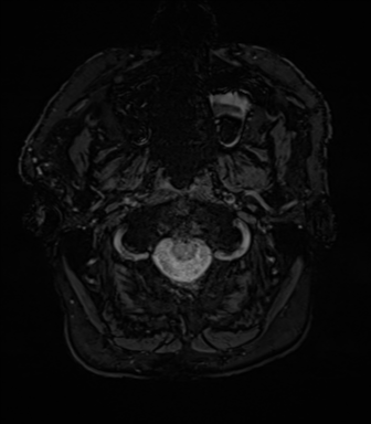 Acoustic schwannoma (Radiopaedia 50846-56358 Axial SWI 2).png