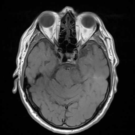 File:Acoustic schwannoma (Radiopaedia 55729-62281 T1 11).png