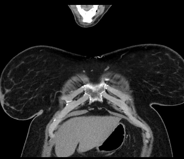 Acromioclavicular joint cyst (Radiopaedia 58455-65610 Coronal C+ arterial phase 28).jpg