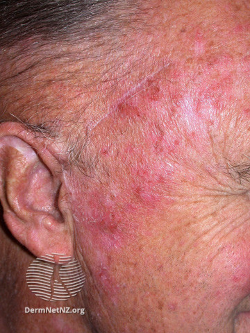 File:Actinic Keratoses treated with imiquimod (DermNet NZ lesions-ak-imiquimod-3765).jpg