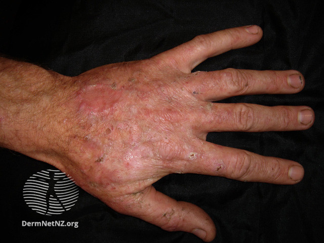 File:Actinic keratoses affecting the hands (DermNet NZ lesions-ak-hands-289).jpg