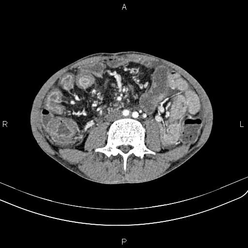 Active crohn disease (Radiopaedia 87133-103397 Axial C+ arterial phase 59).jpg