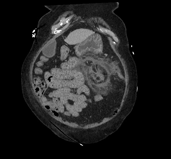 File:Active renal extravasation with large subcapsular and retroperitoneal hemorrhage (Radiopaedia 60975-68796 Coronal C+ portal venous phase 38).jpg
