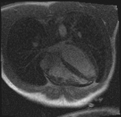 File:Active right ventricular cardiac sarcoidosis (Radiopaedia 55596-62100 Axial Dynamic perfusion scan MOCO 50).jpg