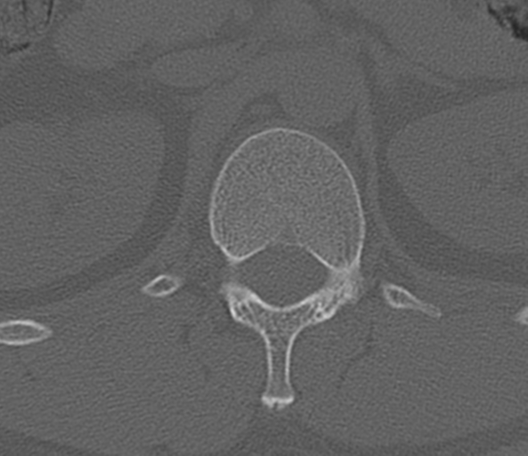 File:Acute L1 burst compression fracture (Radiopaedia 34430-35755 Axial bone window 13).png
