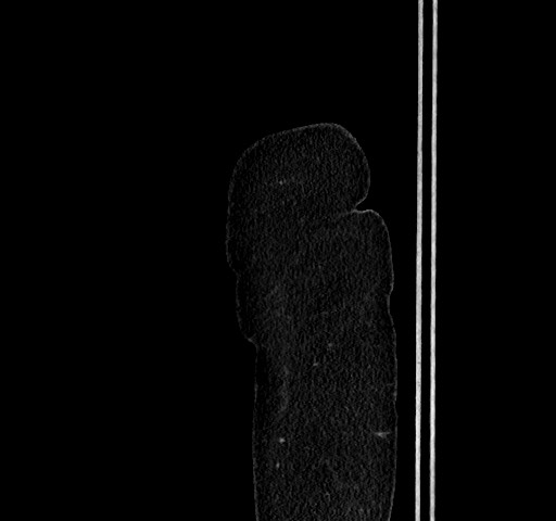 Acute appendicitis, heterotaxy syndrome (Radiopaedia 66884-76202 Sagittal C+ portal venous phase 5).jpg