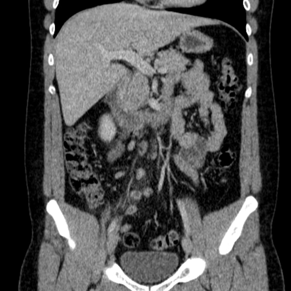 Acute appendicitis (Radiopaedia 38255-40270 Coronal C+ portal venous phase 40).jpg