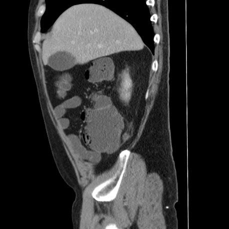 Acute appendicitis (Radiopaedia 66513-75790 Sagittal C+ portal venous phase 30).jpg