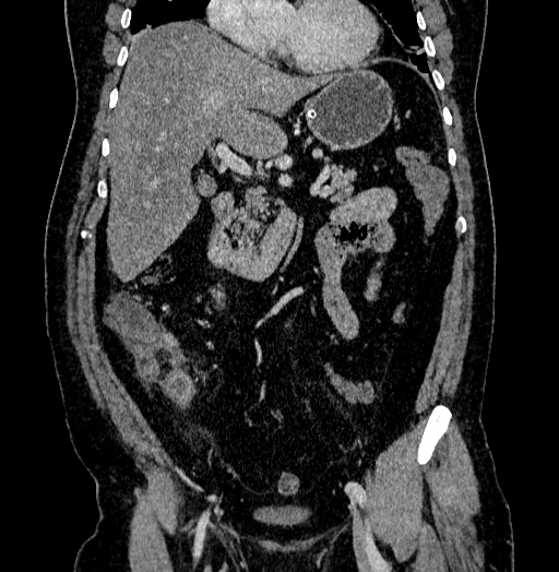 Acute appendicitis (Radiopaedia 79950-93224 Coronal C+ portal venous phase 41).jpg