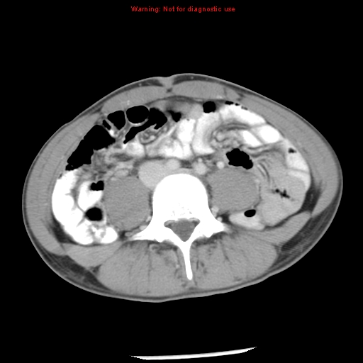 Acute appendicitis (Radiopaedia 8195-9045 Axial C+ portal venous phase 45).jpg
