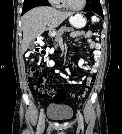Acute appendicitis (Radiopaedia 84780-100240 Coronal C+ portal venous phase 28).jpg