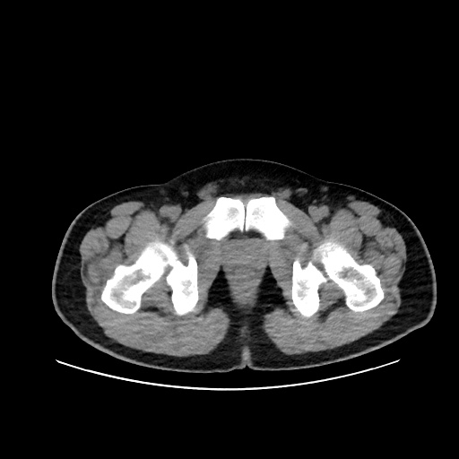 Acute appendicitis and COVID 19 pneumonia (Radiopaedia 76604-88380 Axial non-contrast 122).jpg