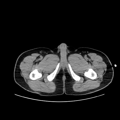 Acute appendicitis and COVID 19 pneumonia (Radiopaedia 76604-88380 Axial non-contrast 129).jpg