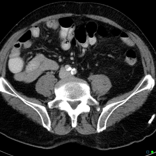 File:Acute appendicitis arising from a malrotated cecum (Radiopaedia 19970-19997 Axial C+ portal venous phase 25).jpg