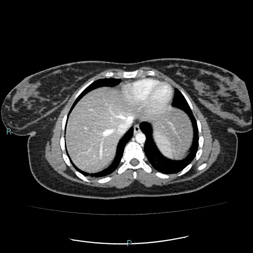 Acute bilateral pyelonephritis (Radiopaedia 37146-38881 Axial C+ portal venous phase 6).jpg