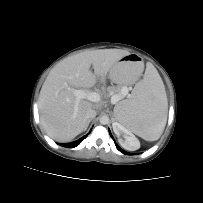 File:Acute calculous cholecystitis in patient with osteopetrosis (Radiopaedia 77871-90159 Axial C+ portal venous phase 28).jpg